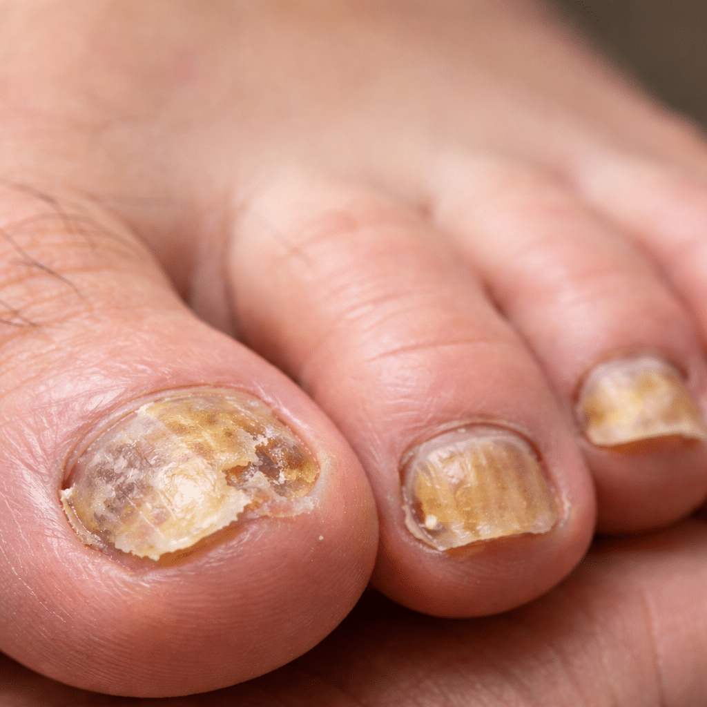 Educational image of fungal toenails (onychomycosis) showing thickened, yellowed nail plates